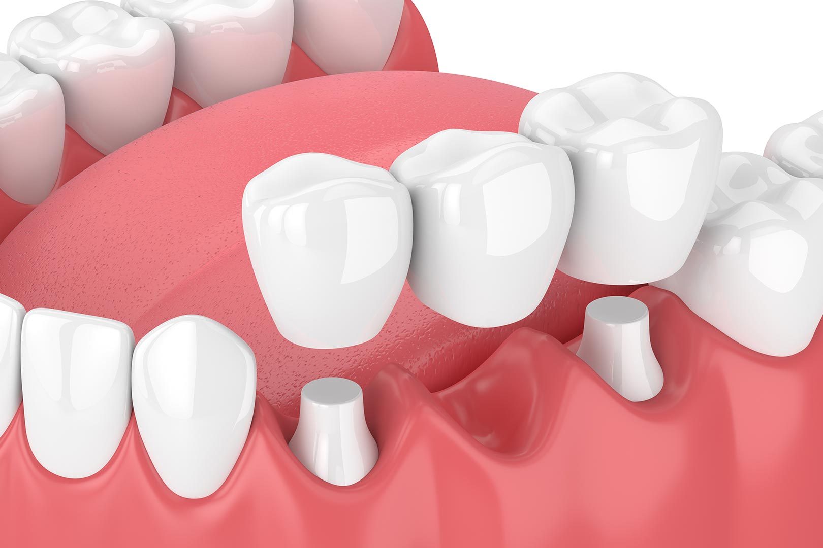 Dental bridge process | Prairie Dental | General & Family Dentist | Leduc, AB