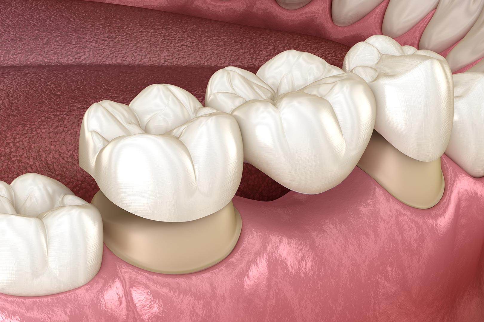 Leduc Dental Bridges | Prairie Dental | General & Family Dentist | Leduc, AB