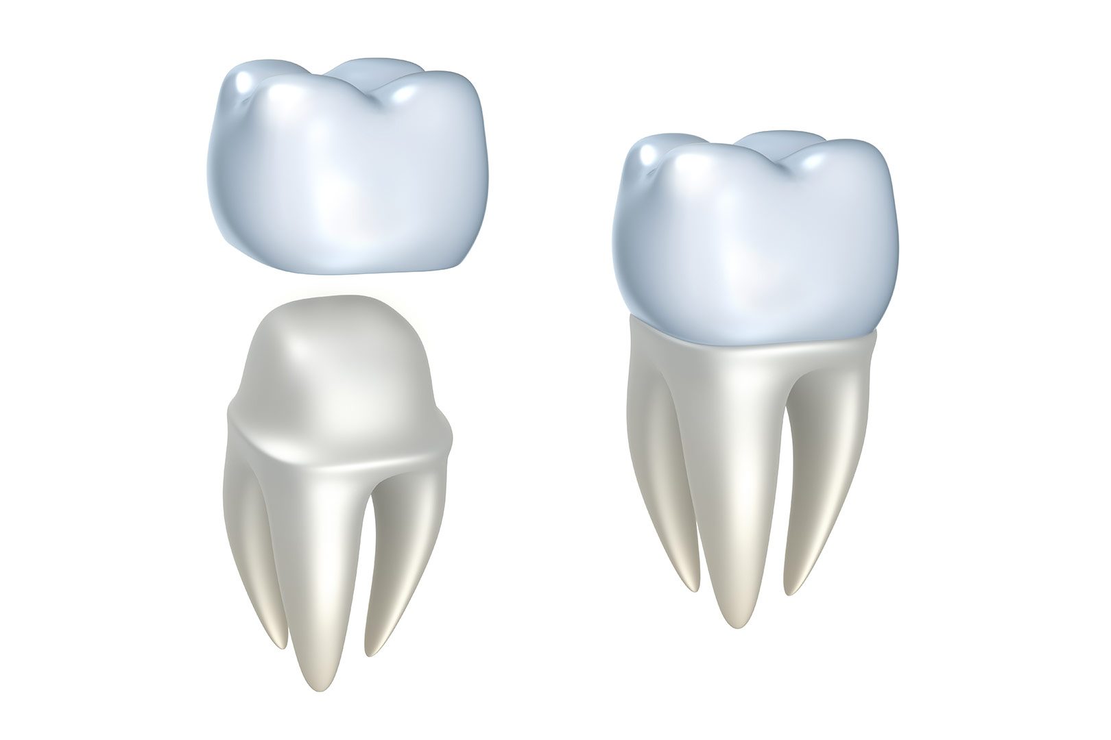 Dental Crowns | Prairie Dental | General & Family Dentist | Leduc, AB