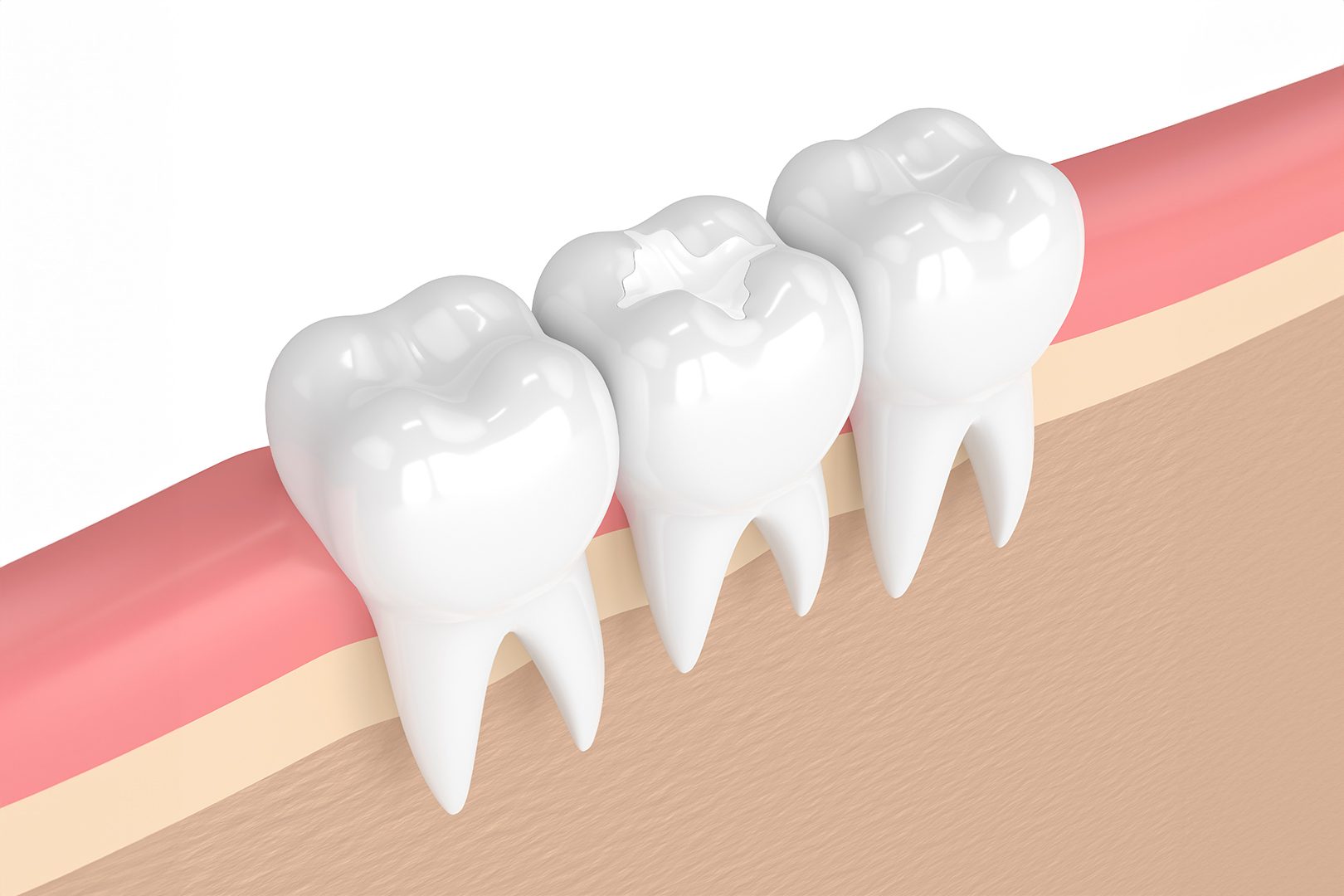Dental filling benefits | Prairie Dental | General & Family Dentist | Leduc, AB