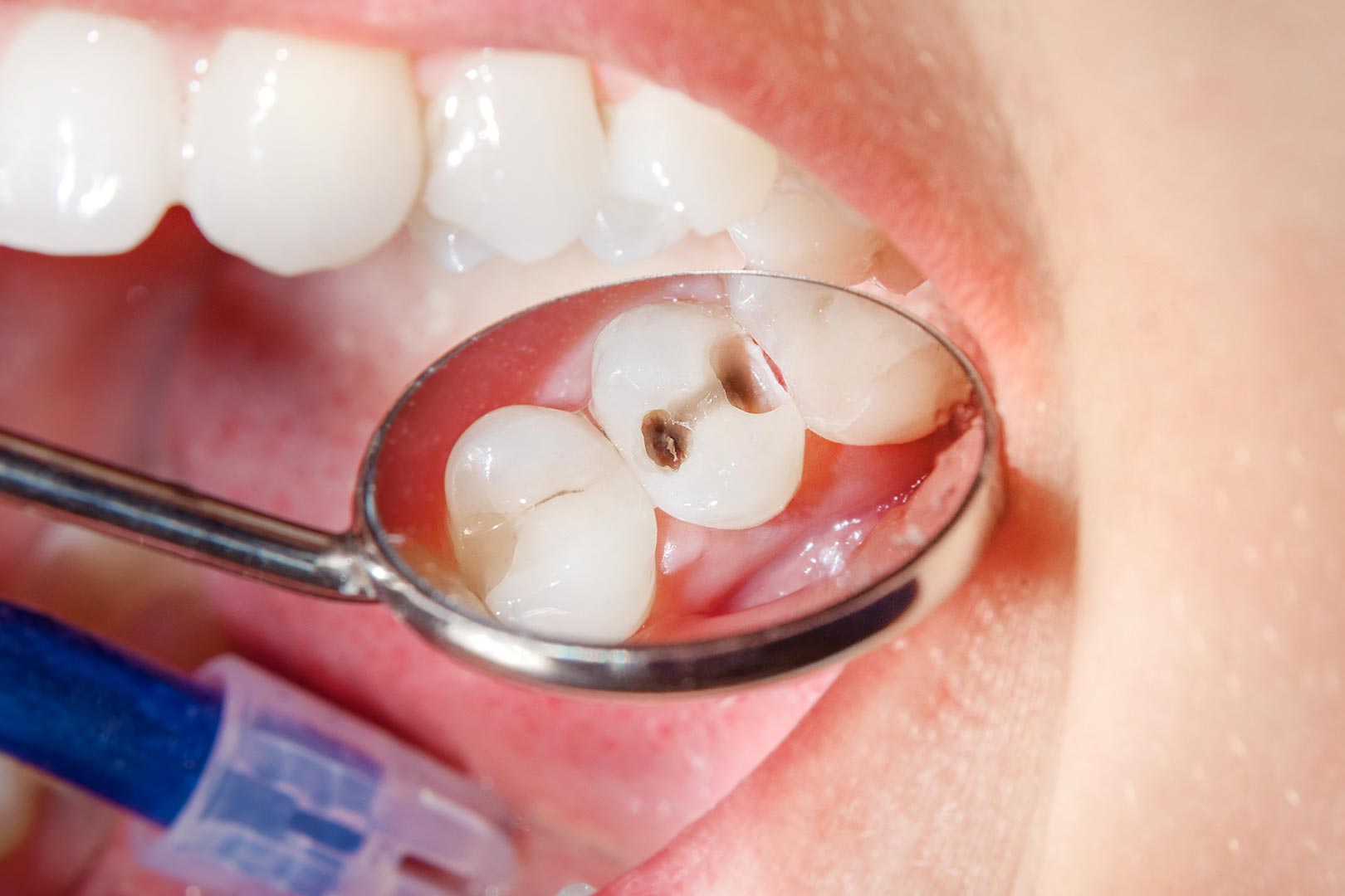 Dental Fillings Leduc | Prairie Dental | General & Family Dentist | Leduc, AB