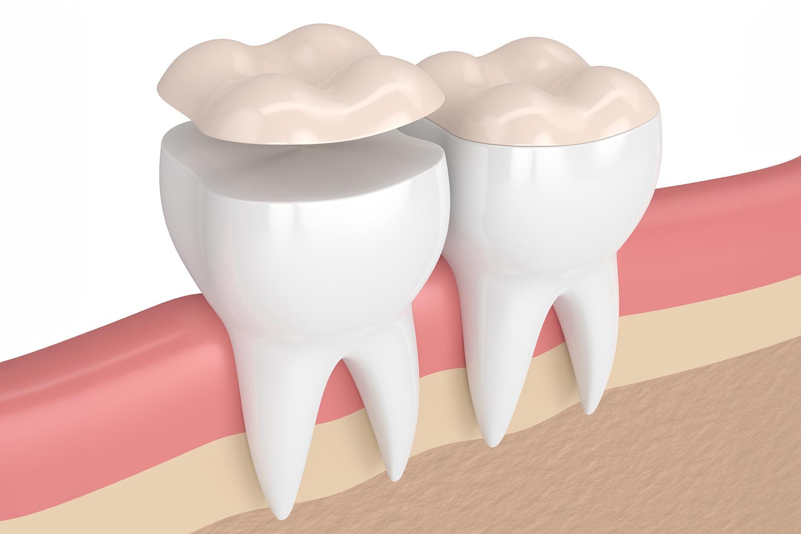Dental inlays and onlays | Prairie Dental | General & Family Dentist | Leduc, AB