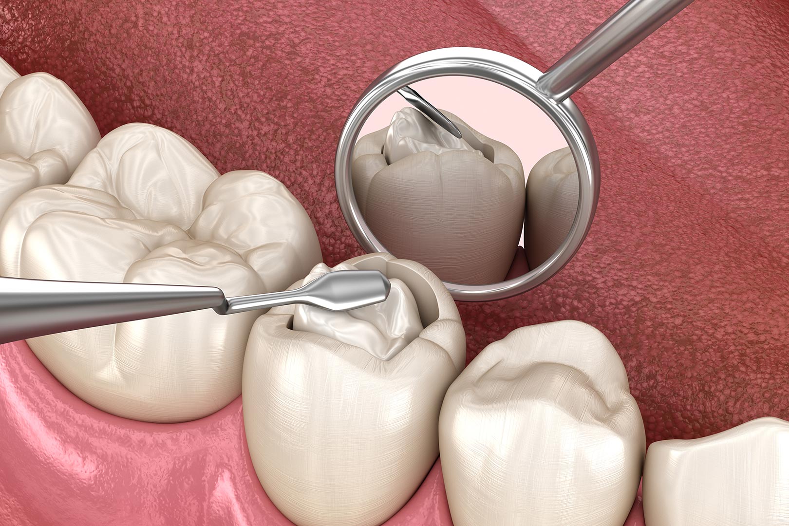 Dental inlays and onlays process | Prairie Dental | General & Family Dentist | Leduc, AB