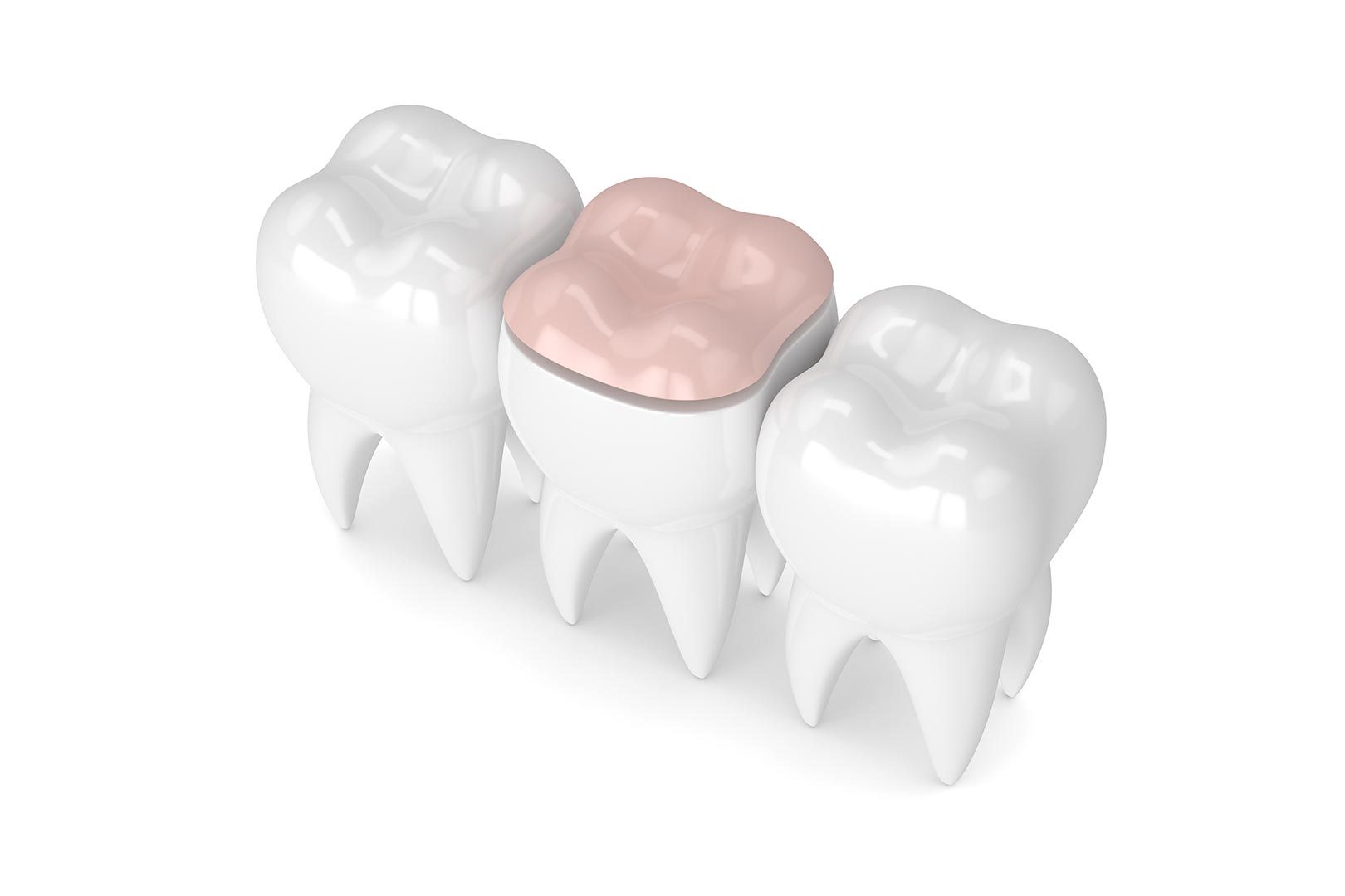 Dental inlays and onlays service | Prairie Dental | General & Family Dentist | Leduc, AB