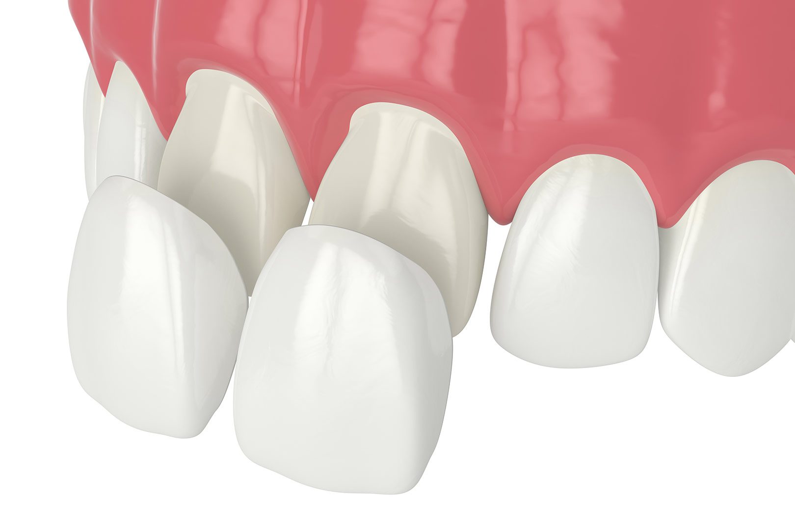 Porcelain Veneer Application Process | Prairie Dental | General & Family Dentist | Leduc, AB