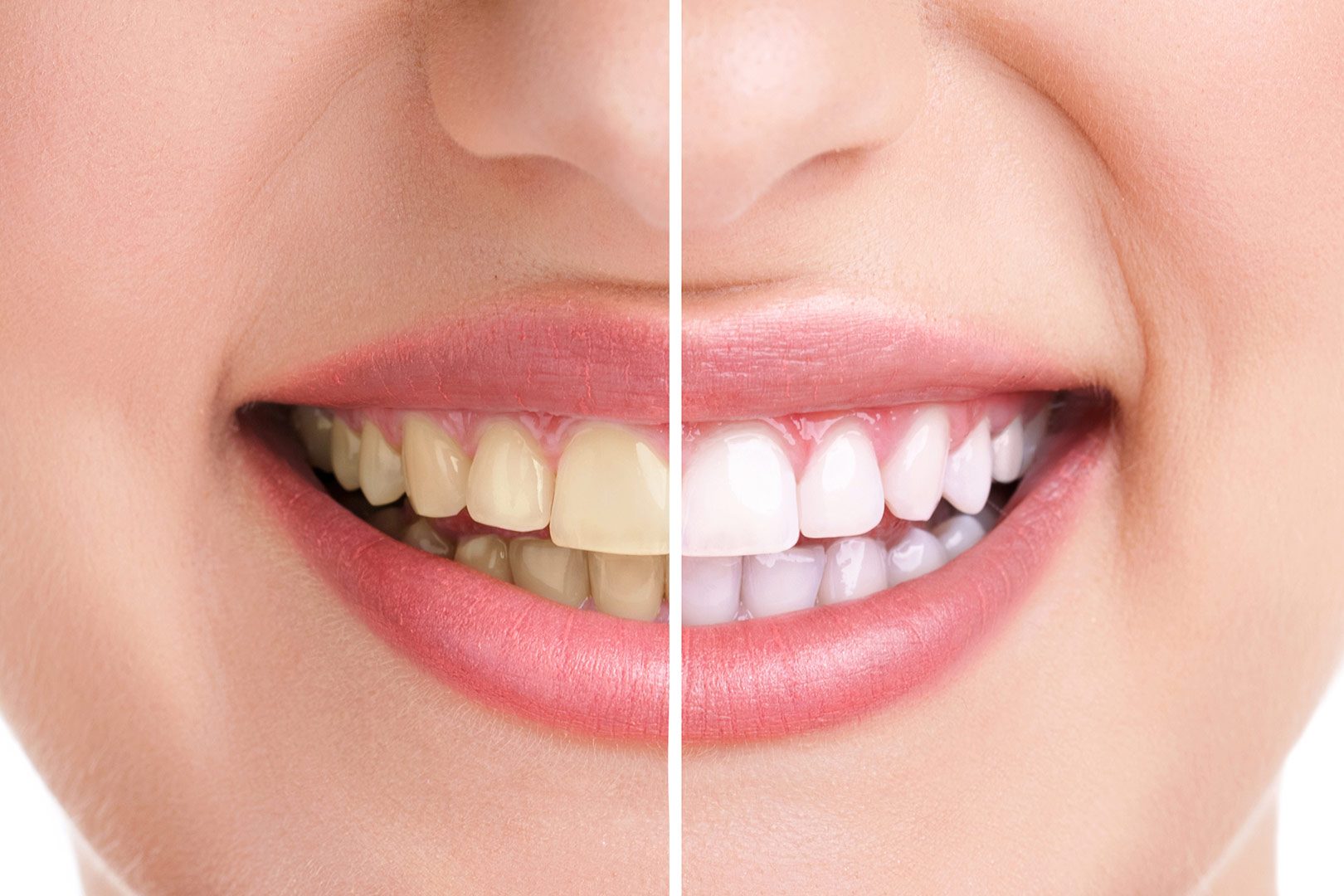 Teeth Whitening Leduc | Prairie Dental | General & Family Dentist | Leduc, AB