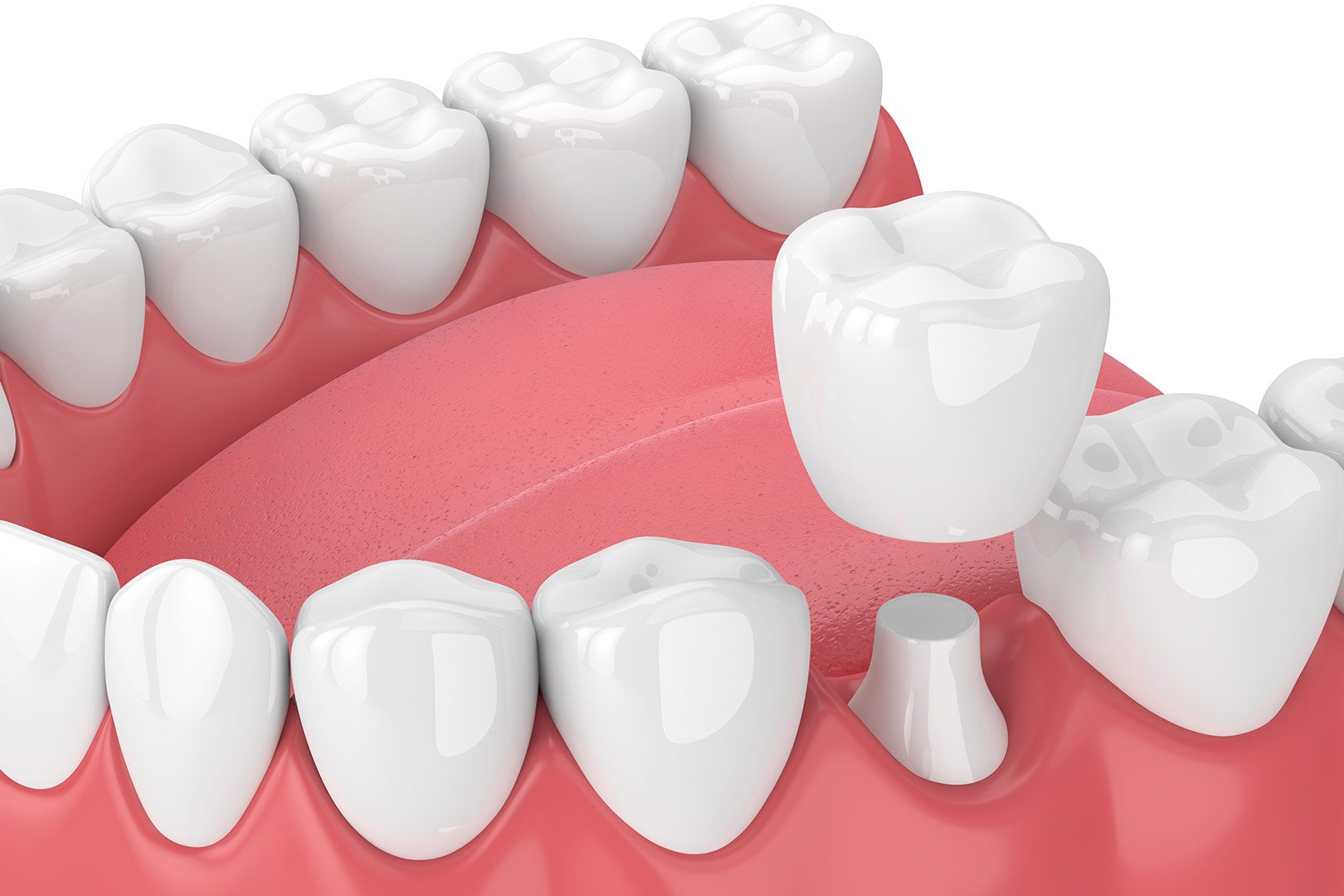 What are dental crowns | Prairie Dental | General & Family Dentist | Leduc, AB