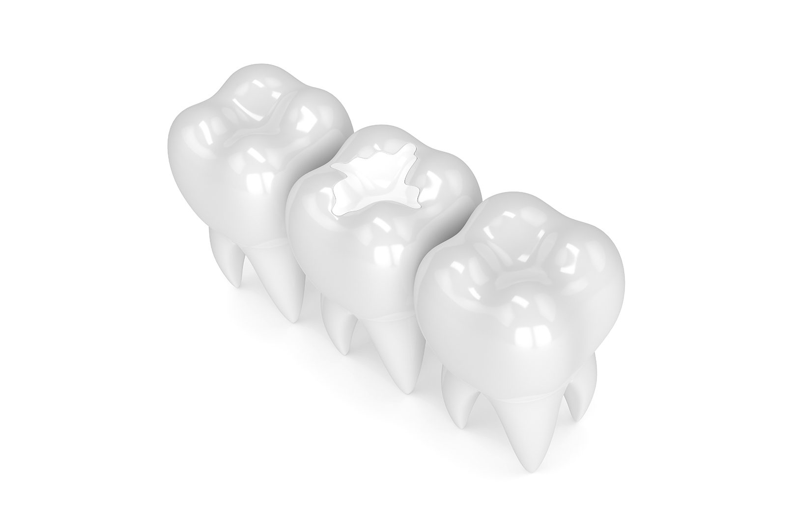 What are dental fillings | Prairie Dental | General & Family Dentist | Leduc, AB