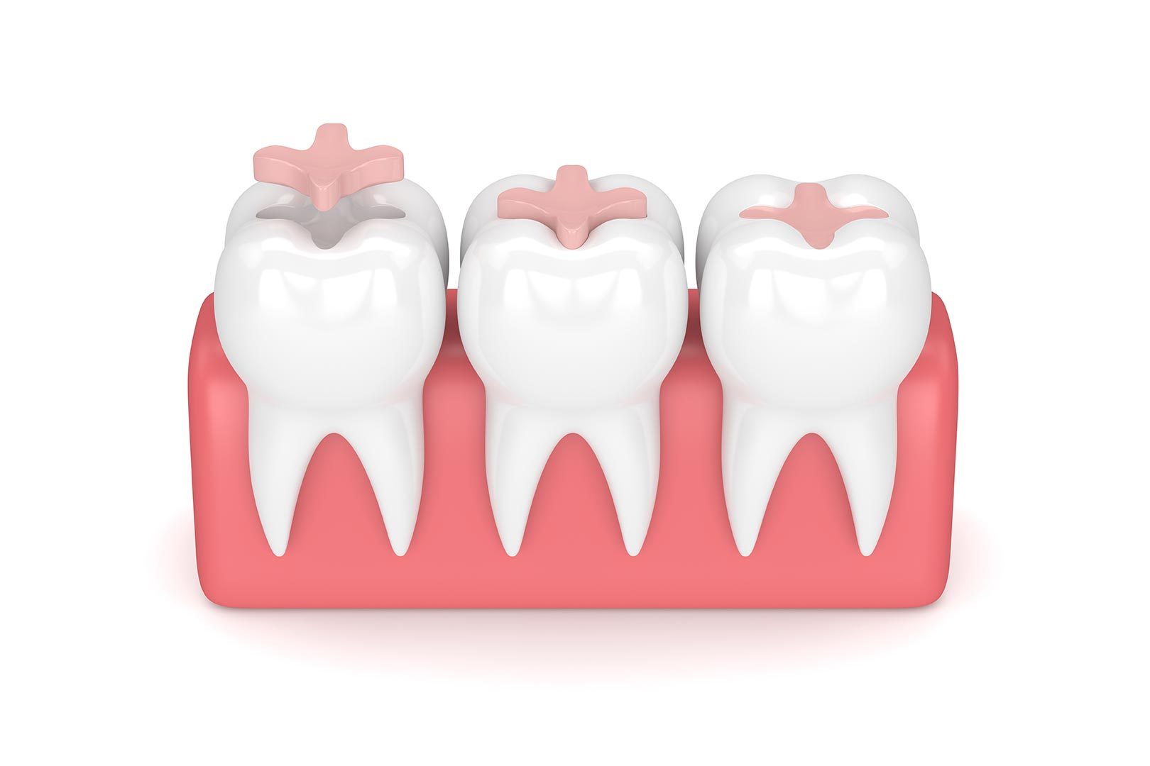 What are dental inlays and onlays | Prairie Dental | General & Family Dentist | Leduc, AB