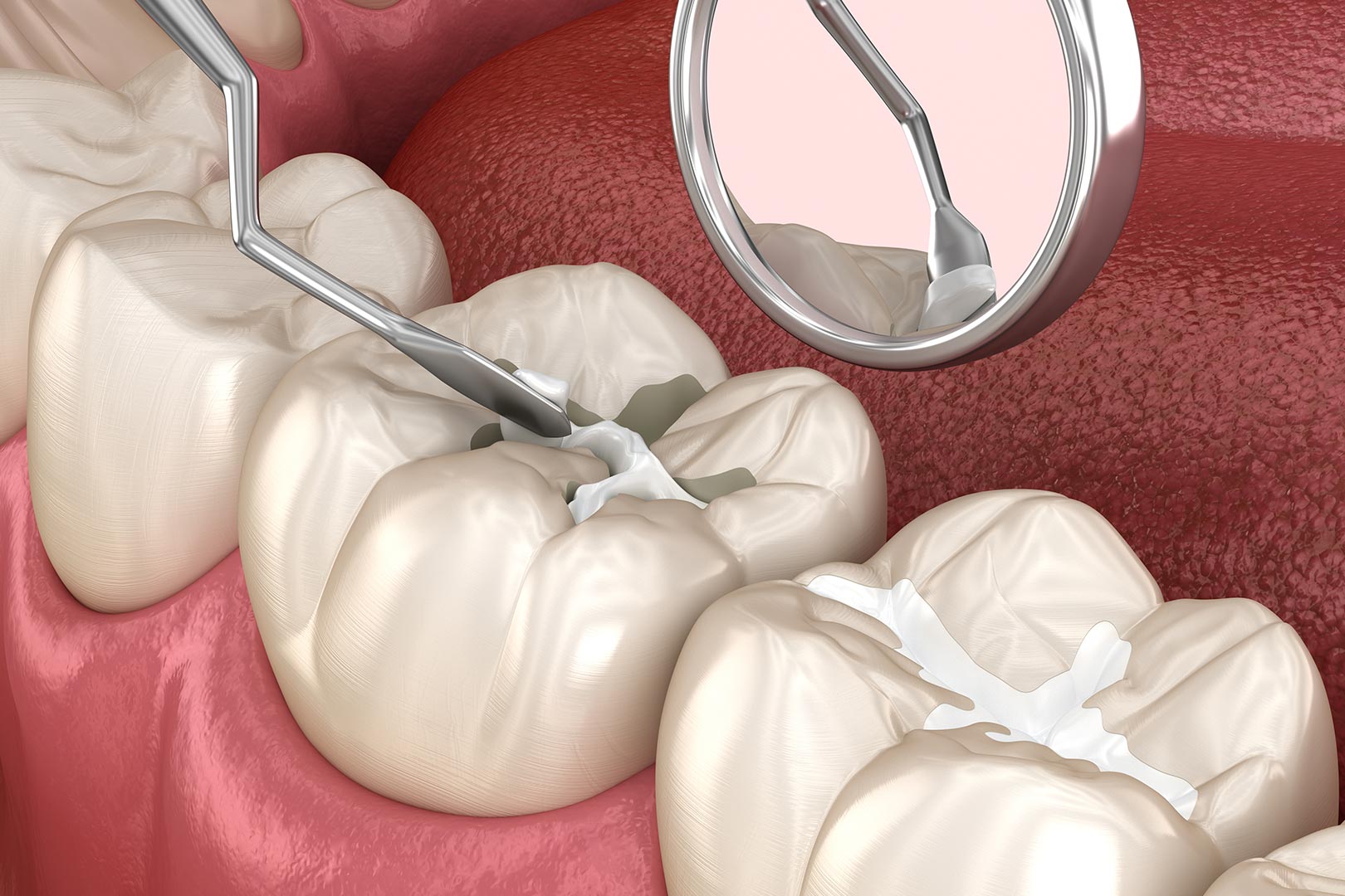 What are dental sealants | Prairie Dental | General & Family Dentist | Leduc, AB