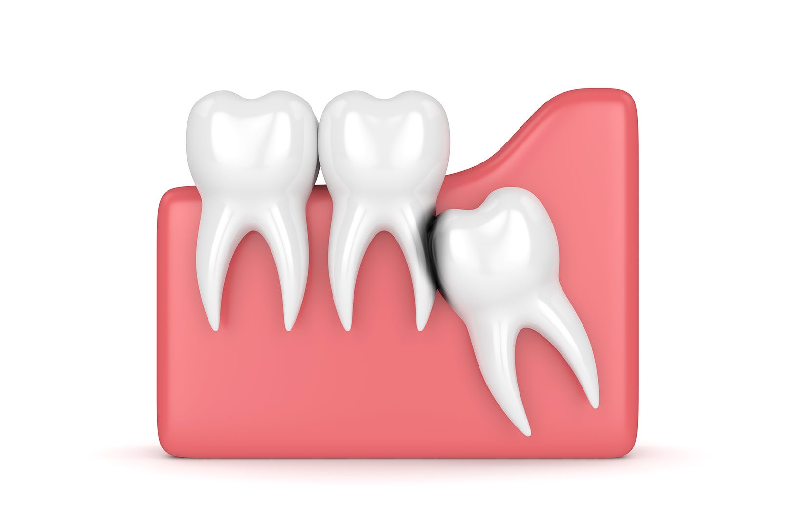 Wisdom teeth extraction | Prairie Dental | General & Family Dentist | Leduc, AB