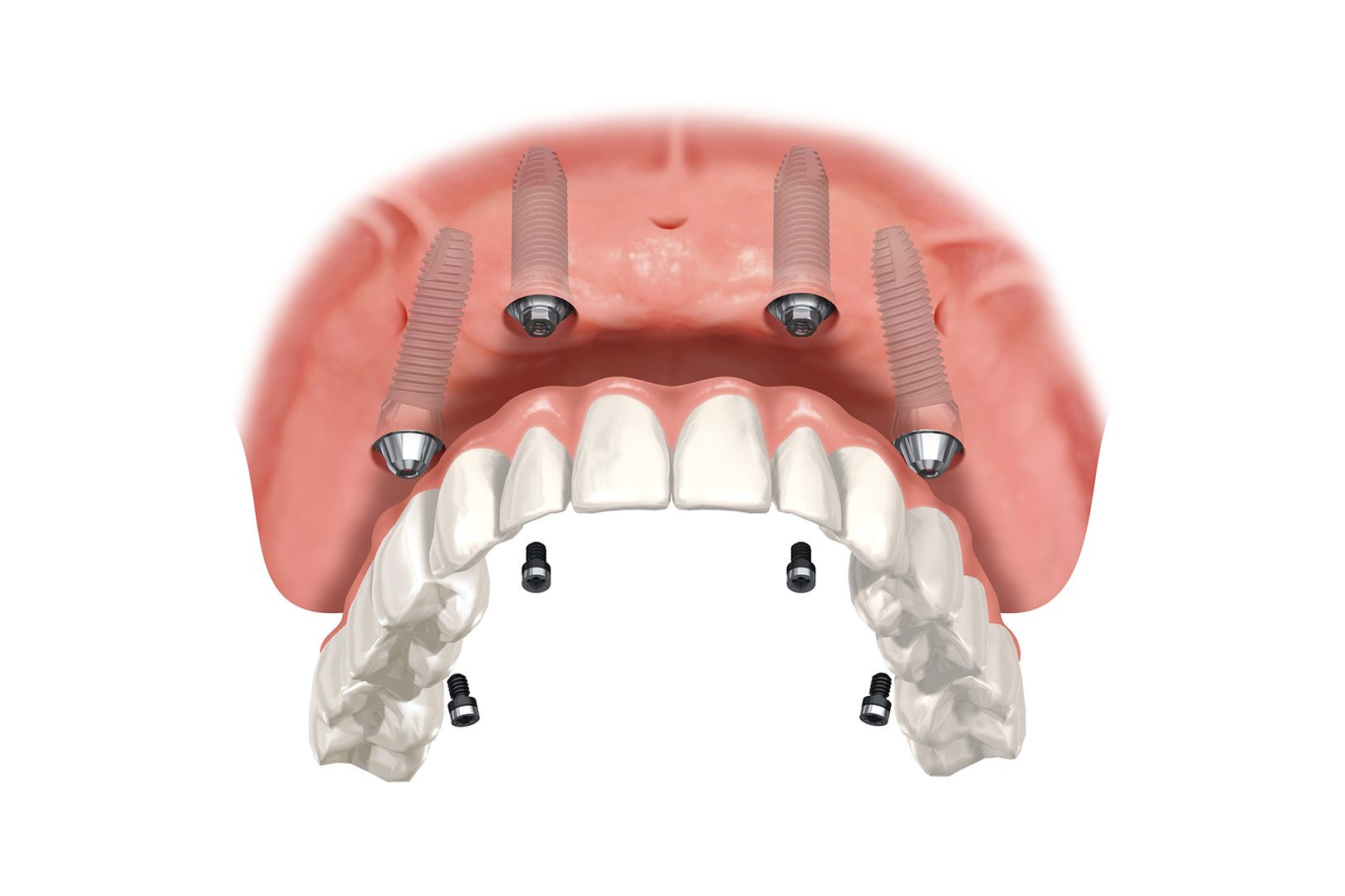 All on x implants | Prairie Dental | General & Family Dentist | Leduc, AB