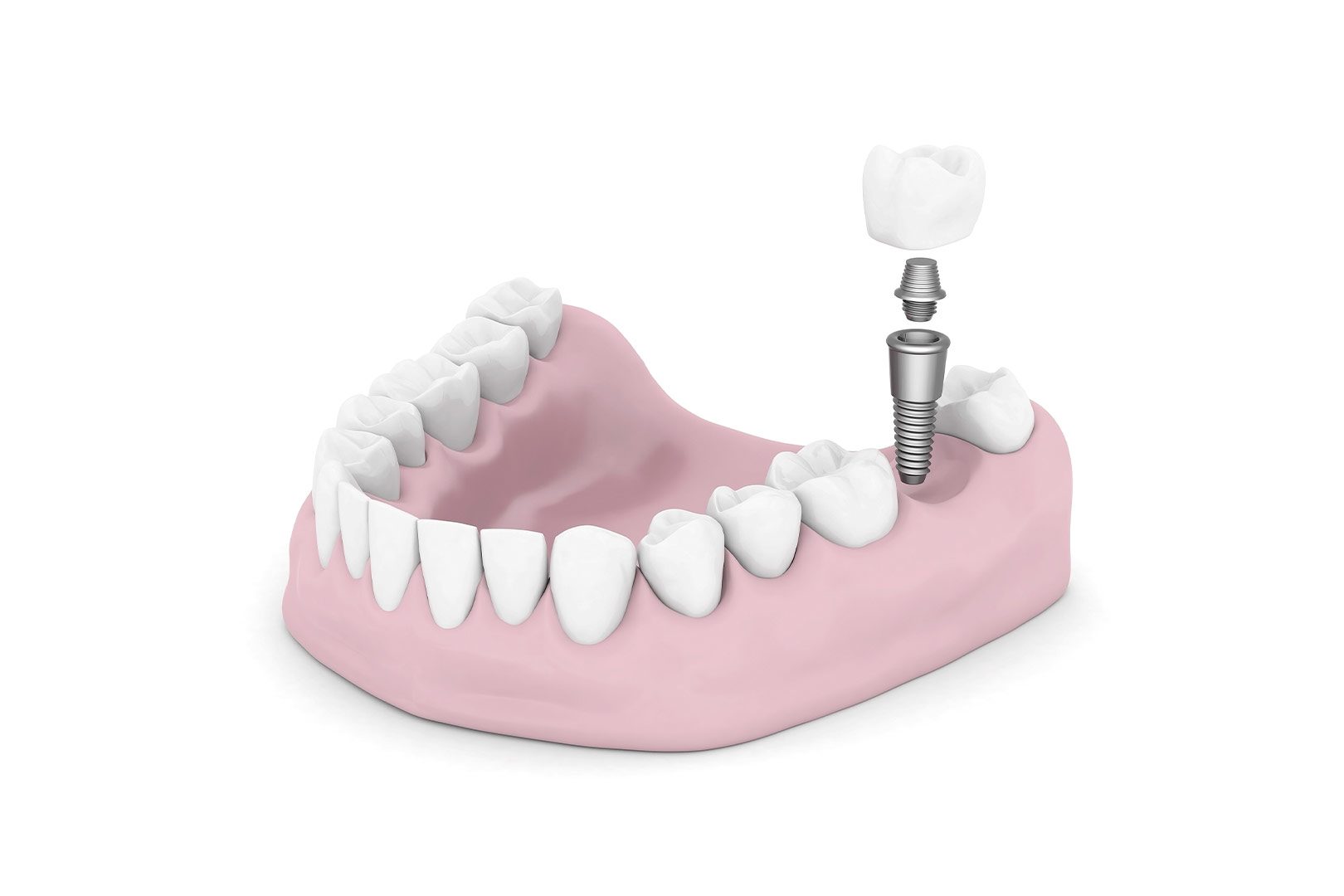 Dental Implants Service | Prairie Dental | General & Family Dentist | Leduc, AB