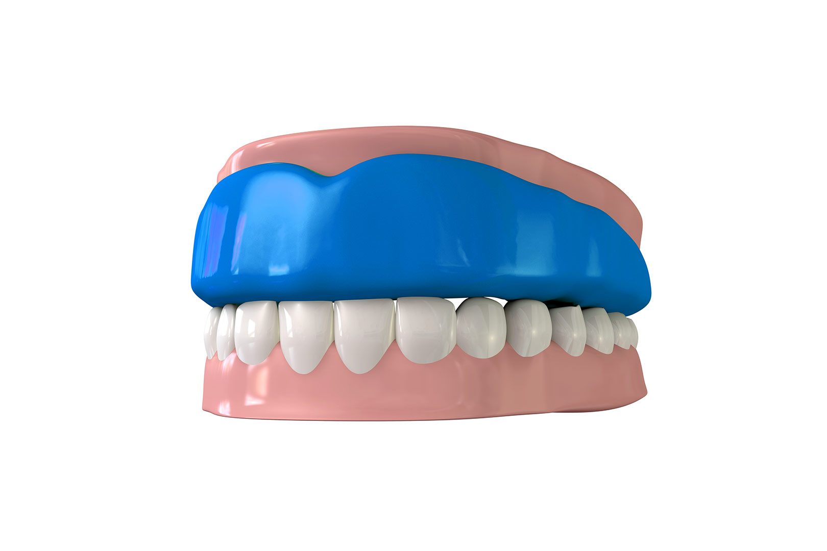 Sports Mouthguards | Prairie Dental | General & Family Dentist | Leduc, AB