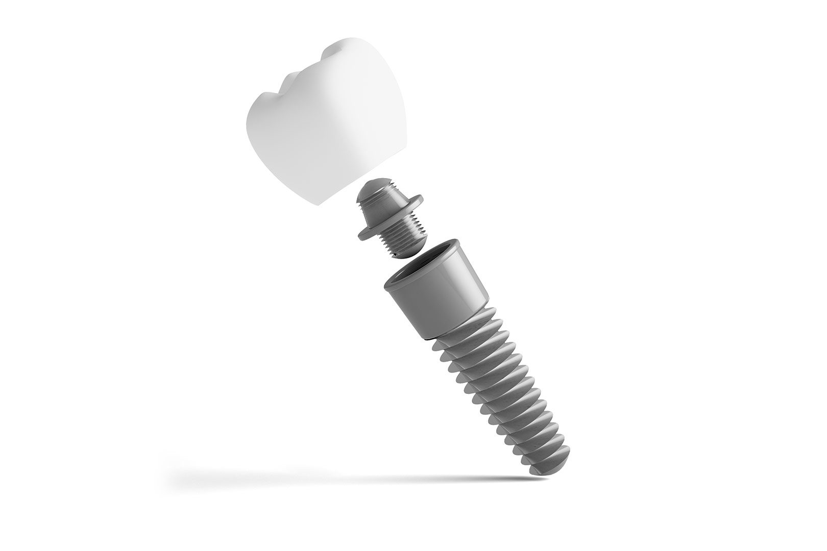 What are dental implants | Prairie Dental | General & Family Dentist | Leduc, AB