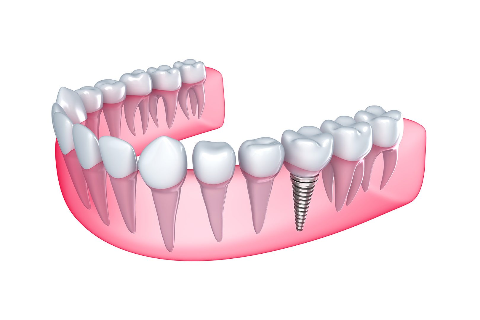 What is implant dentistry | Prairie Dental | General & Family Dentist | Leduc, AB